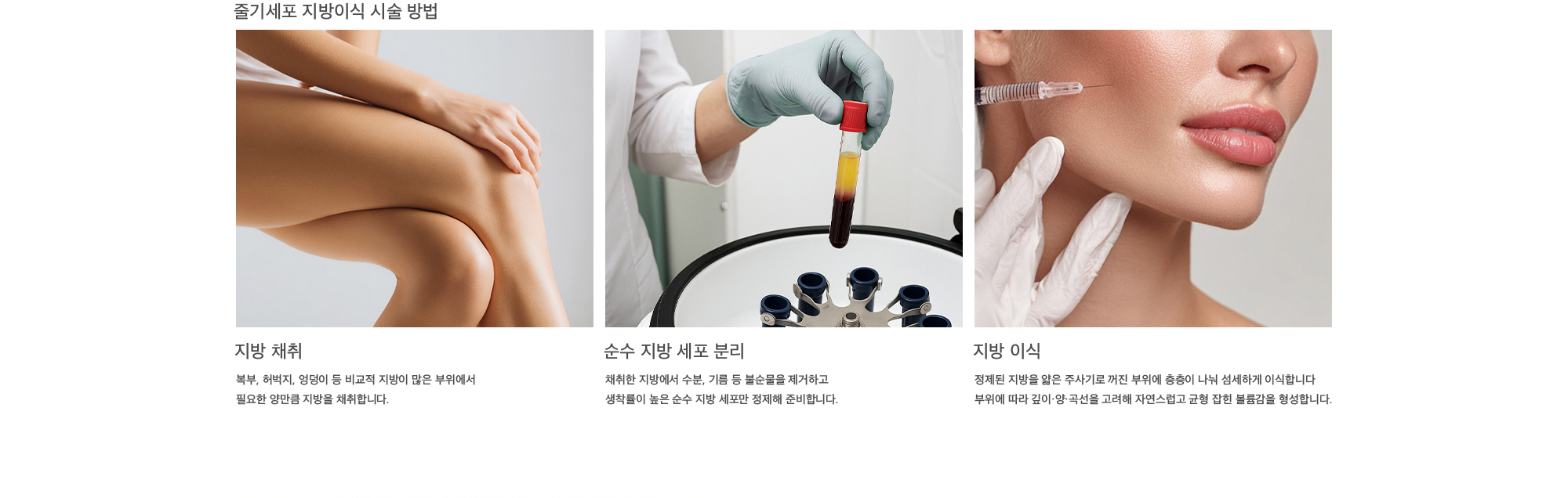 줄기세포 지방이식 시술 방법 지방 채취 : 복부, 허벅지, 엉덩이 등 비교적 지방이 많은 부위에서 필요한 양만큼 지방을 채취합니다. 순수 지방 세포 분리 : 채취한 지방에서 수분, 기름 등 불순물을 제거하고 생착률이 높은 순수 지방 세포만 정제해 준비합니다. 지방 이식 : 정제된 지방을 얇은 주사기로 꺼진 부위에 층층이 나눠 섬세하게 이식합니다 부위에 따라 깊이·양·곡선을 고려해 자연스럽고 균형 잡힌 볼륨감을 형성합니다.