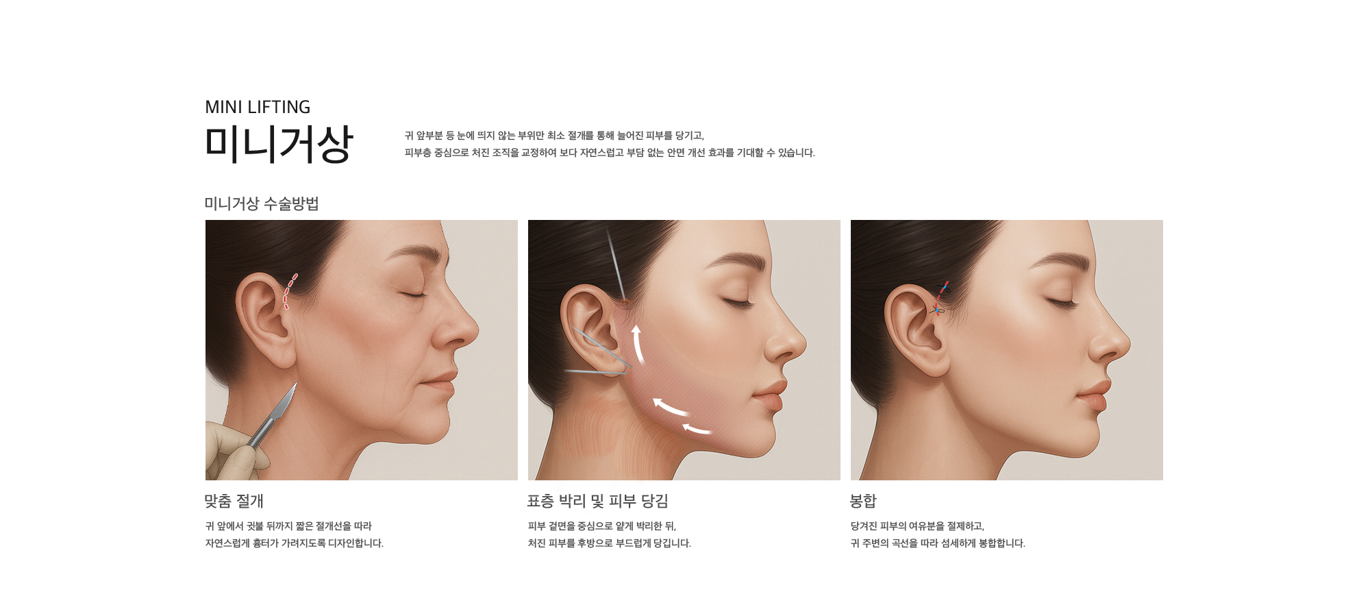 미니거상 귀 앞부분 등 눈에 띄지 않는 부위만 최소 절개를 통해 늘어진 피부를 당기고, 피부층 중심으로 처진 조직을 교정하여 보다 자연스럽고 부담 없는 안면 개선 효과를 기대할 수 있습니다.