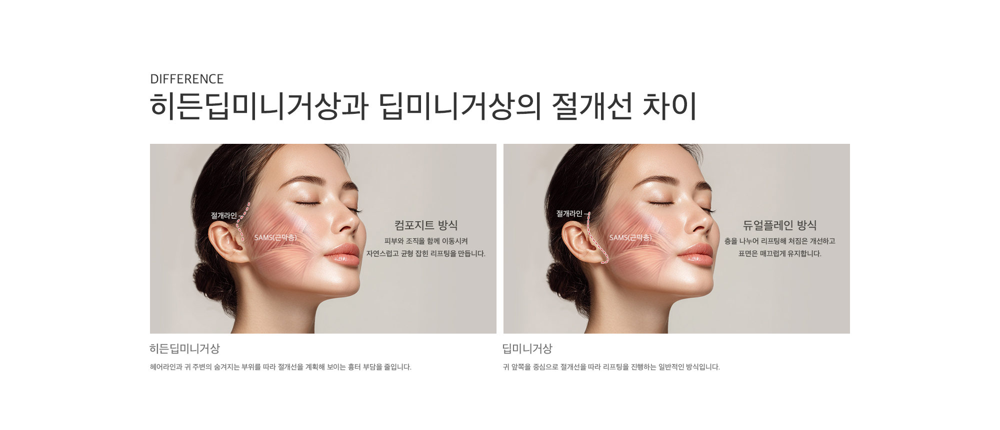 히든딥미니거상과 딥미니거상의 절개선 차이 | 히든딥미니거상 : 헤어라인과 귀 주변의 숨겨지는 부위를 따라 절개선을 계획해 보이는 흉터 부담을 줄입니다. 딥미니거상 : 귀 앞쪽을 중심으로 절개선을 따라 리프팅을 진행하는 일반적인 방식입니다.