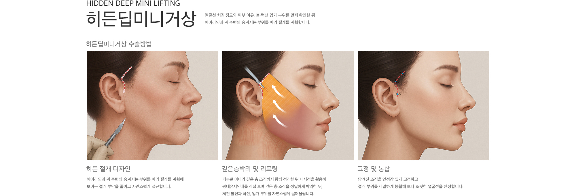 얼굴선 처짐 정도와 피부 여유, 볼·턱선·입가 부위를 먼저 확인한 뒤 헤어라인과 귀 주변의 숨겨지는 부위를 따라 절개를 계획합니다.