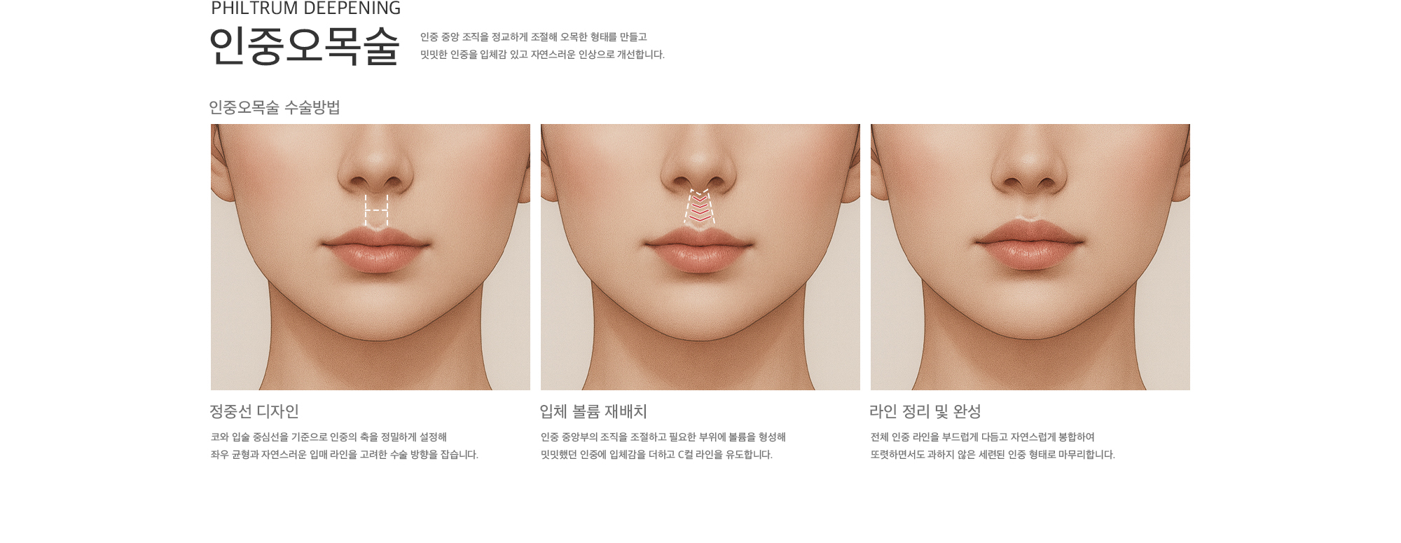 인중 중앙 조직을 정교하게 조절해 오목한 형태를 만들고 밋밋한 인중을 입체감 있고 자연스러운 인상으로 개선합니다. 정중선 디자인 | 입체 볼륨 재배치 | 라인 정리 및 완성