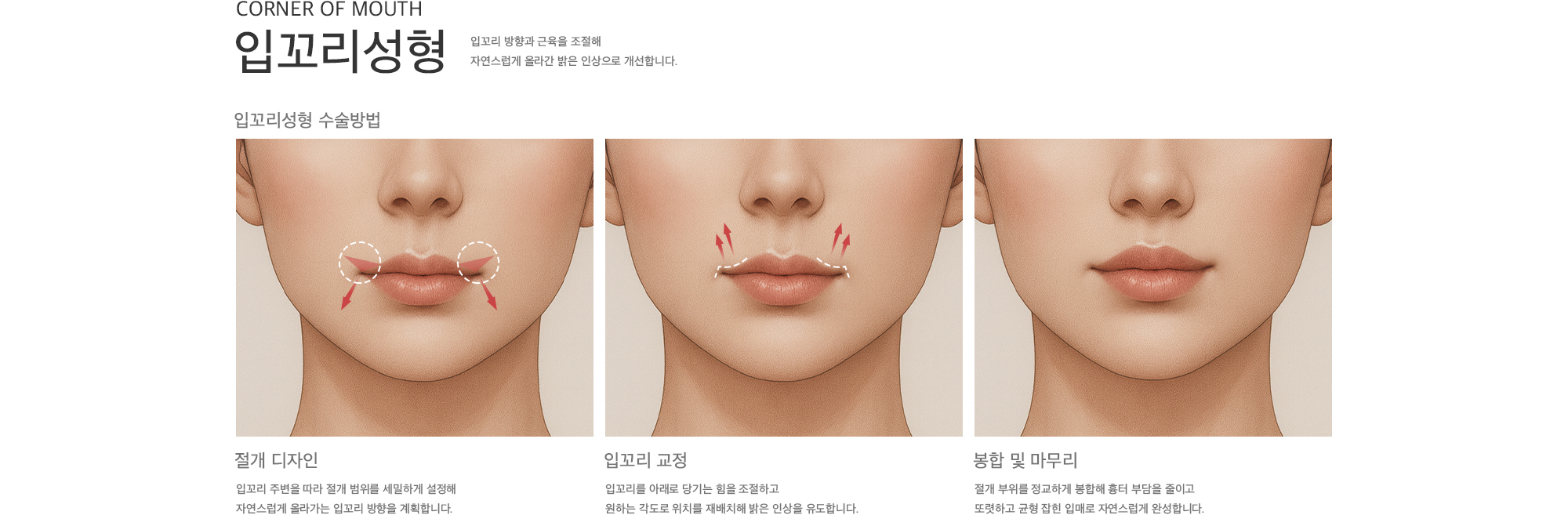 입꼬리 방향과 근육을 조절해 자연스럽게 올라간 밝은 인상으로 개선합니다. 절개 디자인 | 입꼬리 교정 | 봉합 및 마무리