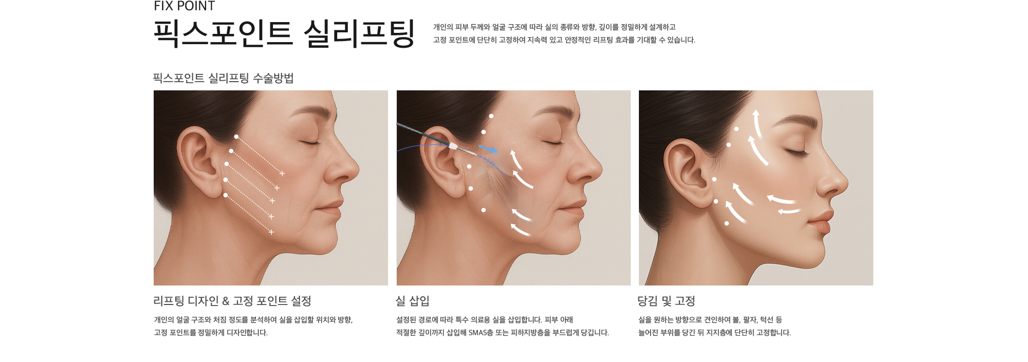 
        픽스포인트 실리프팅 개인의 피부 두께와 얼굴 구조에 따라 실의 종류와 방향, 깊이를 정밀하게 설계하고 고정 포인트에 단단히 고정하여 지속력 있고 안정적인 리프팅 효과를 기대할 수 있습니다.
        리프팅 디자인 & 고정 포인트 설정 : 개인의 얼굴 구조와 처짐 정도를 분석하여 실을 삽입할 위치와 방향, 고정 포인트를 정밀하게 디자인합니다.
        실 삽입 : 설정된 경로에 따라 특수 의료용 실을 삽입합니다. 피부 아래 적절한 깊이까지 삽입해 SMAS층 또는 피하지방층을 부드럽게 당깁니다.
        당김 및 고정 : 실을 원하는 방향으로 견인하여 볼, 팔자, 턱선 등 늘어진 부위를 당긴 뒤 지지층에 단단히 고정합니다.
        