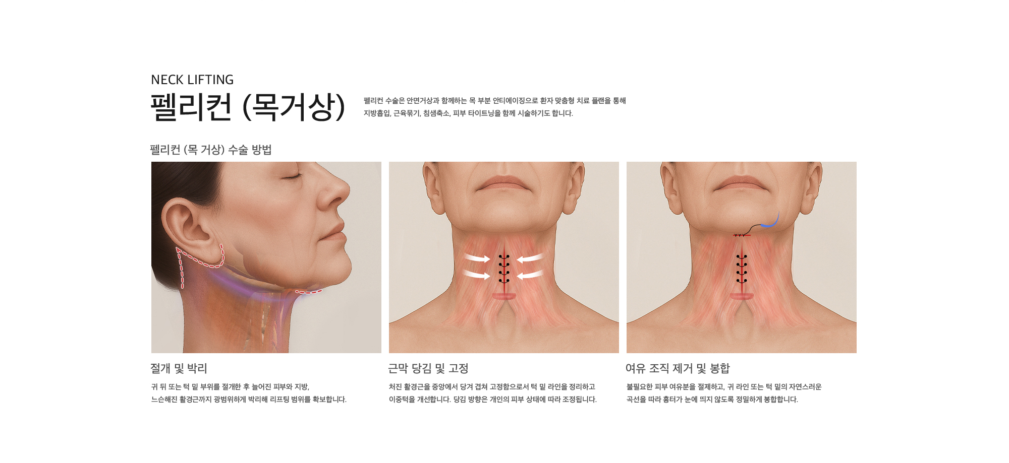 
        펠리컨 (목거상)
        펠리컨 수술은 안면거상과 함께하는 목 부분 안티에이징으로 환자 맞춤형 치료 플랜을 통해
        지방흡입, 근육묶기, 침샘축소, 피부 타이트닝을 함께 시술하기도 합니다.
        절개 및 박리 : 귀 뒤 또는 턱 밑 부위를 절개한 후 늘어진 피부와 지방, 느슨해진 활경근까지 광범위하게 박리해 리프팅 범위를 확보합니다.
        근막 당김 및 고정 : 처진 활경근을 중앙에서 당겨 겹쳐 고정함으로서 턱 밑 라인을 정리하고 이중턱을 개선합니다. 당김 방향은 개인의 피부 상태에 따라 조정됩니다.
        여유 조직 제거 및 봉합 : 불필요한 피부 여유분을 절제하고, 귀 라인 또는 턱 밑의 자연스러운 곡선을 따라 흉터가 눈에 띄지 않도록 정밀하게 봉합합니다.
        