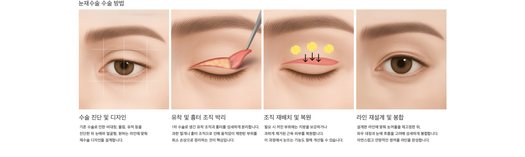 눈재수술 수술 방법 수술 진단 및 디자인 : 기존 수술로 인한 비대칭, 풀림, 유착 등을 진단한 뒤 눈매와 얼굴형, 원하는 라인에 맞춰 재수술 디자인을 설계합니다. 유착 및 흉터 조직 박리 : 1차 수술로 생긴 유착 조직과 흉터를 섬세하게 분리합니다. 과한 절개나 흉터 조직으로 인해 움직임이 제한된 부위를 최소 손상으로 정리하는 것이 핵심입니다. 조직 재배치 및 복원 : 필요 시 꺼진 부위에는 지방을 보강하거나 과하게 제거된 근육·피부를 복원합니다. 이 과정에서 눈뜨는 기능도 함께 개선될 수 있습니다. 라인 재설계 및 봉합 : 설계한 라인에 맞춰 눈꺼풀을 재고정한 뒤,  좌우 대칭과 눈매 흐름을 고려해 섬세하게 봉합합니다. 자연스럽고 안정적인 쌍꺼풀 라인을 완성합니다.