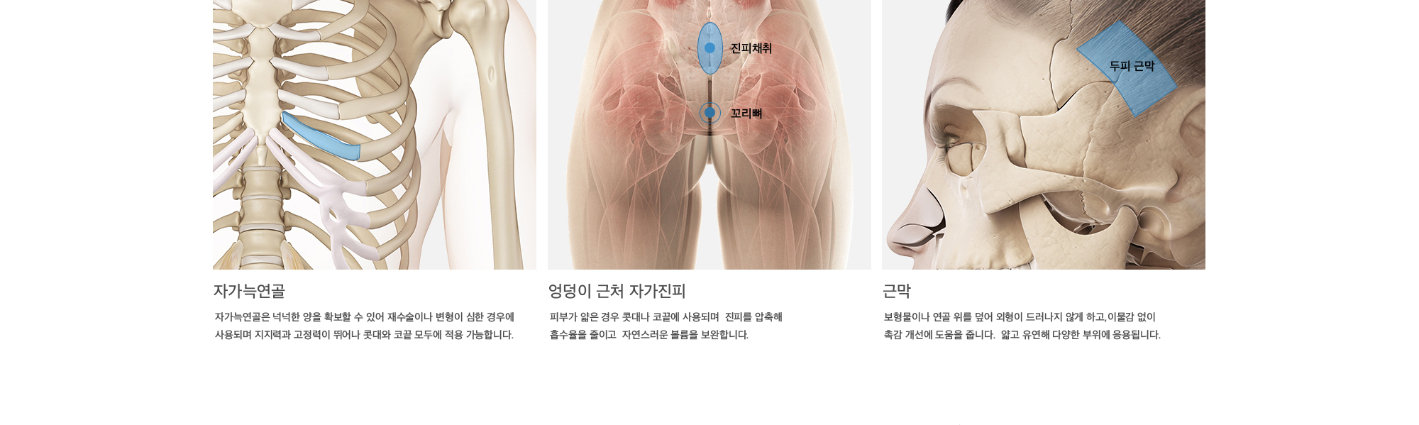 자가늑연골 : 자가늑연골은 넉넉한 양을 확보할 수 있어 재수술이나 변형이 심한 경우에 사용되며 지지력과 고정력이 뛰어나 콧대와 코끝 모두에 적용 가능합니다. 엉덩이 근처 자가진피 : 피부가 얇은 경우 콧대나 코끝에 사용되며  진피를 압축해 흡수율을 줄이고  자연스러운 볼륨을 보완합니다. 근막 : 보형물이나 연골 위를 덮어 외형이 드러나지 않게 하고,이물감 없이 촉감 개선에 도움을 줍니다.  얇고 유연해 다양한 부위에 응용됩니다.