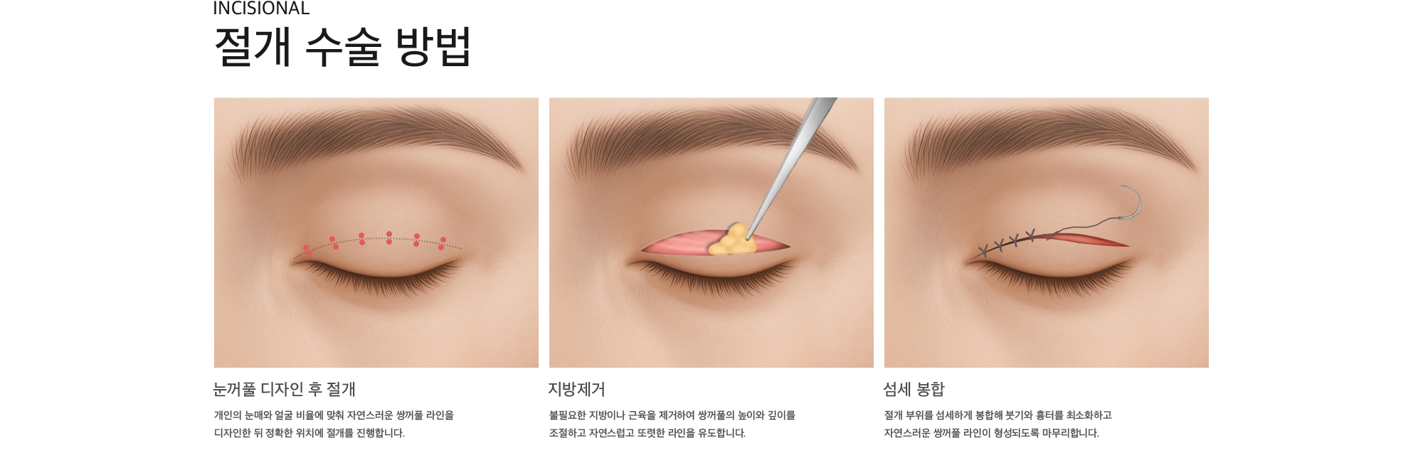 Incisional 절개 수술 방법 눈꺼풀 디자인 후 절개 : 개인의 눈매와 얼굴 비율에 맞춰 자연스러운 쌍꺼풀 라인을 디자인한 뒤 정확한 위치에 절개를 진행합니다. 지방제거 : 불필요한 지방이나 근육을 제거하여 쌍꺼풀의 높이와 깊이를 조절하고 자연스럽고 또렷한 라인을 유도합니다. 섬세 봉합 : 절개 부위를 섬세하게 봉합해 붓기와 흉터를 최소화하고 자연스러운 쌍꺼풀 라인이 형성되도록 마무리합니다.