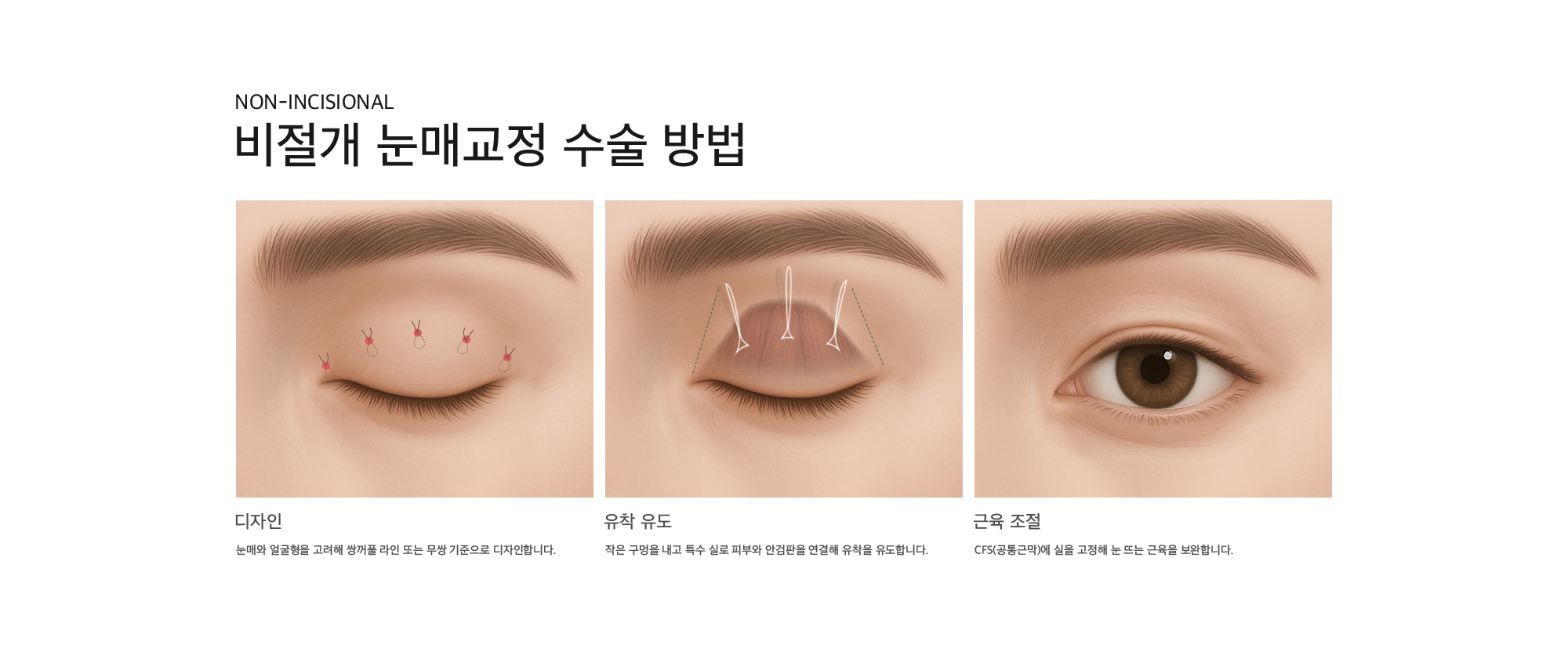 Non-Incisional 비절개 눈매교정 수술 방법 디자인 : 눈매와 얼굴형을 고려해 쌍꺼풀 라인 또는 무쌍 기준으로 디자인합니다. 유착 유도 : 작은 구멍을 내고 특수 실로 피부와 안검판을 연결해 유착을 유도합니다. 근육 조절 : CFS(공통근막)에 실을 고정해 눈 뜨는 근육을 보완합니다.