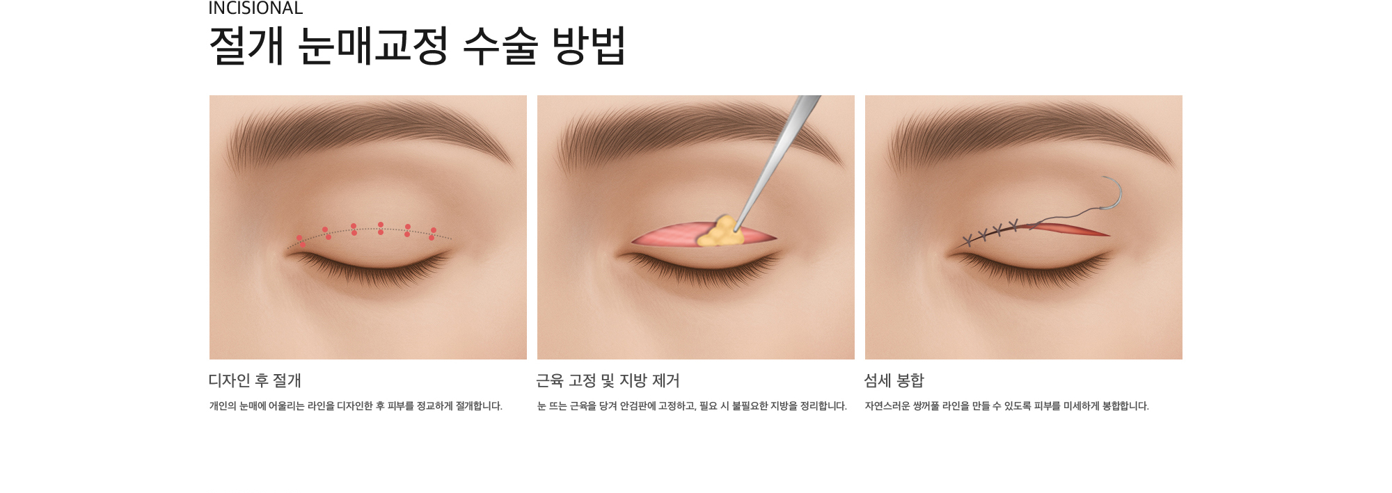 Incisional 절개 눈매교정 수술 방법 디자인 후 절개 : 개인의 눈매에 어울리는 라인을 디자인한 후 피부를 정교하게 절개합니다. 근육 고정 및 지방 제거 : 눈 뜨는 근육을 당겨 안검판에 고정하고, 필요 시 불필요한 지방을 정리합니다. 섬세 봉합 : 자연스러운 쌍꺼풀 라인을 만들 수 있도록 피부를 미세하게 봉합합니다.