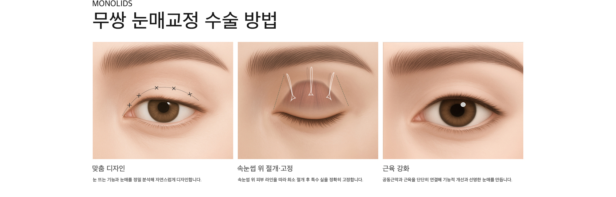 Monolids 무쌍 눈매교정 수술 방법 맞춤 디자인 : 눈 뜨는 기능과 눈매를 정밀 분석해 자연스럽게 디자인합니다. 속눈썹 위 절개·고정 : 속눈썹 위 피부 라인을 따라 최소 절개 후 특수 실을 정확히 고정합니다. 근육 강화 : 공동근막과 근육을 단단히 연결해 기능적 개선과 선명한 눈매를 만듭니다.