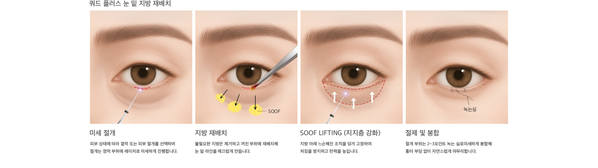 쿼드 플러스 눈 밑 지방 재배치 미세 절개 : 피부 상태에 따라 결막 또는 피부 절개를 선택하며 절개는 점막 부위에 레이저로 미세하게 진행합니다. 지방 재배치 : 불필요한 지방은 제거하고 꺼진 부위에 재배치해 눈 밑 라인을 매끄럽게 만듭니다. SOOF lifting (지지층 강화) : 지방 아래 느슨해진 조직을 당겨 고정하여 처짐을 방지하고 탄력을 높입니다. 절제 및 봉합 : 절개 부위는 2~3포인트 녹는 실로미세하게 봉합해 흉터 부담 없이 자연스럽게 마무리합니다.