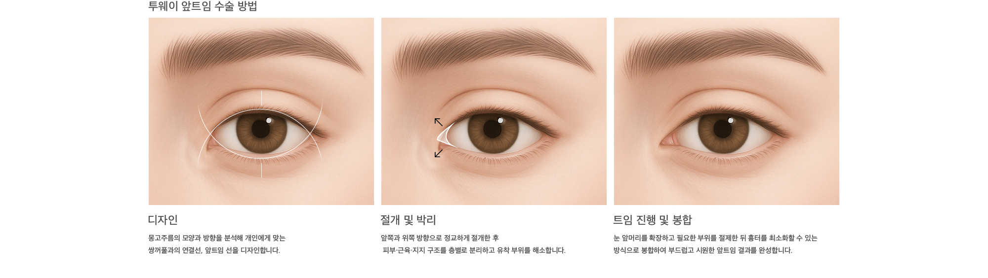 투웨이 앞트임 수술 방법 디자인 : 몽고주름의 모양과 방향을 분석해 개인에게 맞는 쌍꺼풀과의 연결선, 앞트임 선을 디자인합니다. 절개 및 박리 : 앞쪽과 위쪽 방향으로 정교하게 절개한 후 피부·근육·지지 구조를 층별로 분리하고 유착 부위를 해소합니다. 트임 진행 및 봉합 : 눈 앞머리를 확장하고 필요한 부위를 절제한 뒤 흉터를 최소화할 수 있는 방식으로 봉합하여 부드럽고 시원한 앞트임 결과를 완성합니다.