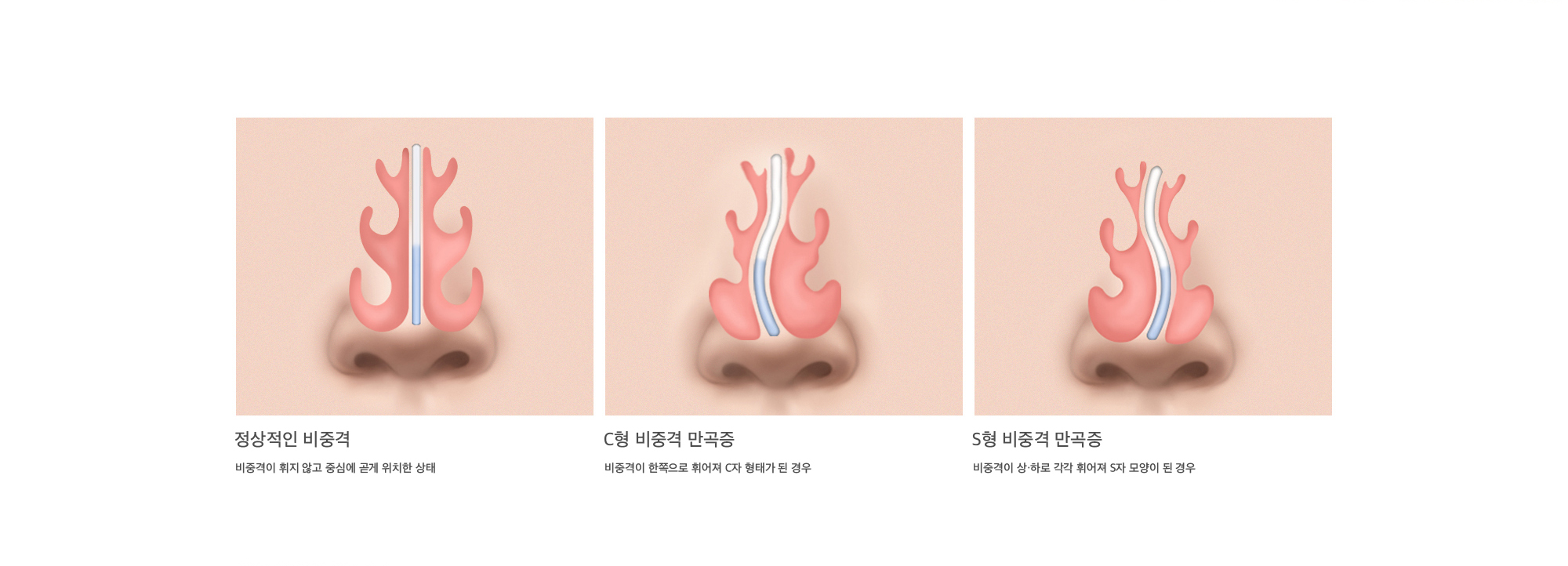 정상적인 비중격 : 비중격이 휘지 않고 중심에 곧게 위치한 상태, C형 비중격 만곡증 : 비중격이 한쪽으로 휘어져 C자 형태가 된 경우, S형 비중격 만곡증 : 비중격이 상·하로 각각 휘어져 S자 모양이 된 경우